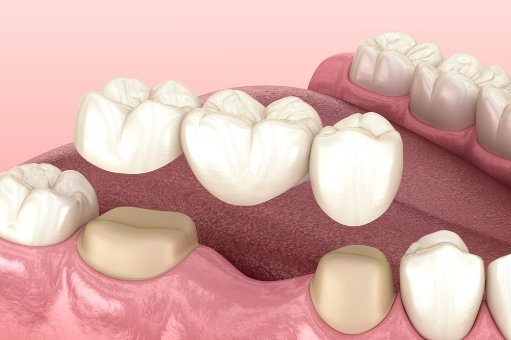 Dental bridge of 3 teeth over molar and premolar.